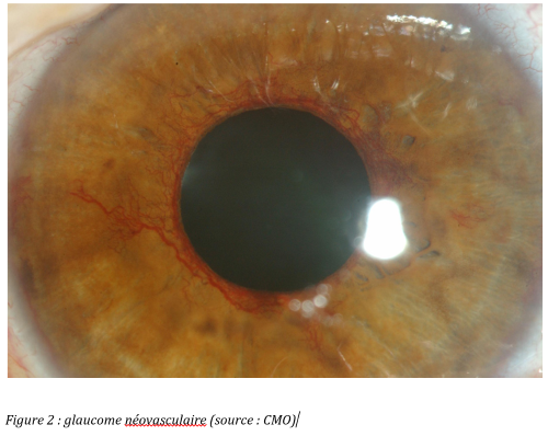 Retinopathiediabvisuel2