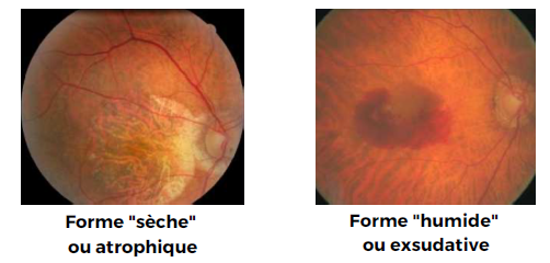 forme sèche et forme humide