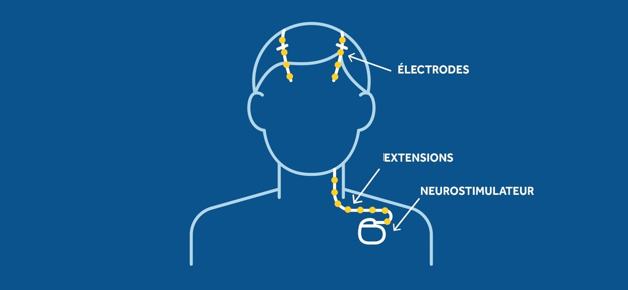 stimulation cérébrale