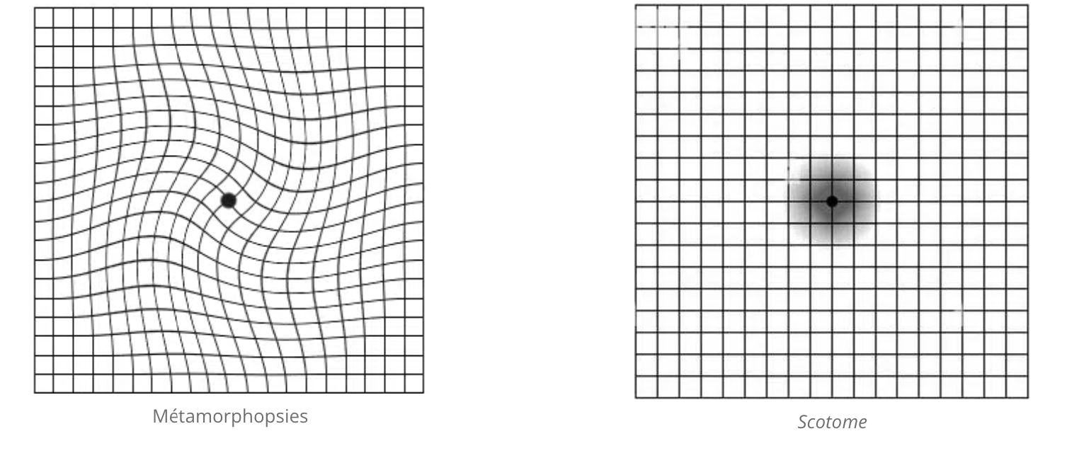 grille d'amsler