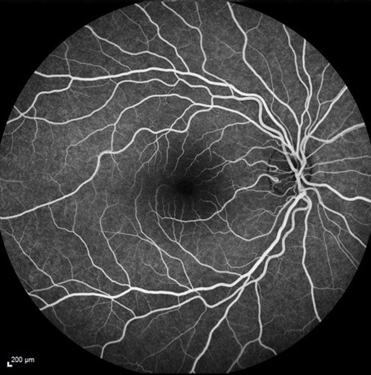 angiographie DMLA