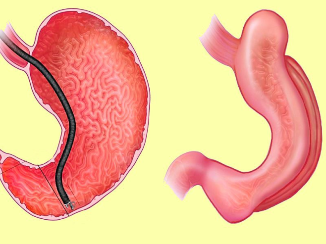 Endosleeve ou plicature endoscopique