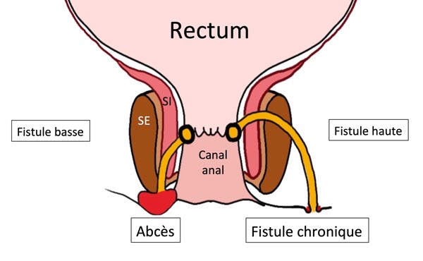 Fistule anale - Chirurgie digestive procto Clinique Mutualiste AÉSIO Santé Saint-Etienne