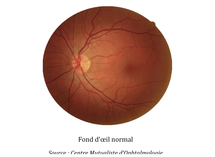 GlaucomeVisu1