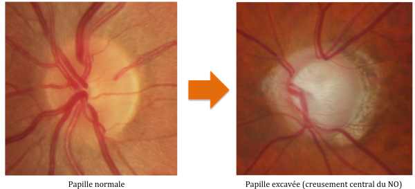 GlaucomeVisu2