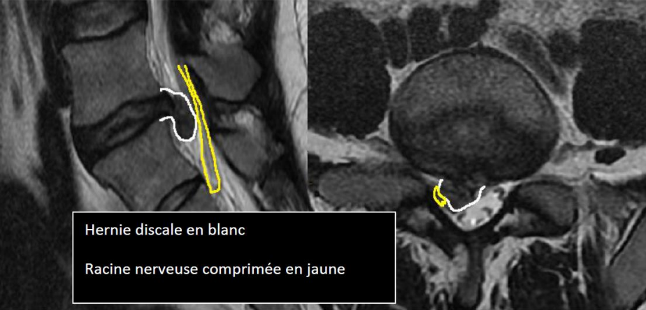 La hernie discale lombaire | AÉSIO Santé