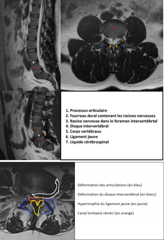 Le canal lombaire étroit | AÉSIO Santé