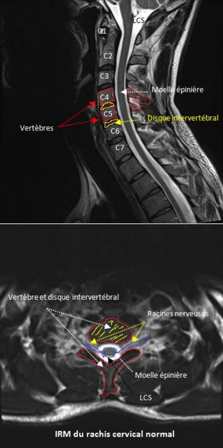 La hernie discale cervicale | AÉSIO Santé