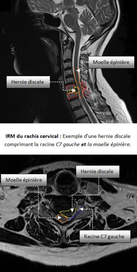Hernie Discale Cervicale