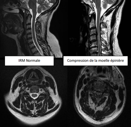 myelopathie cervicarthrosique