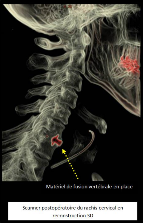 La hernie discale cervicale | AÉSIO Santé