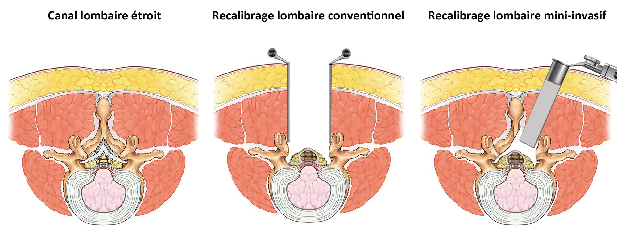Recalibrage canal lombaire étroit