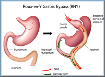 Roux en Y Gastric Bypass