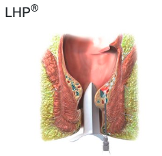 Traitement LHP - Hemorroides chirurgie AÉSIO Santé