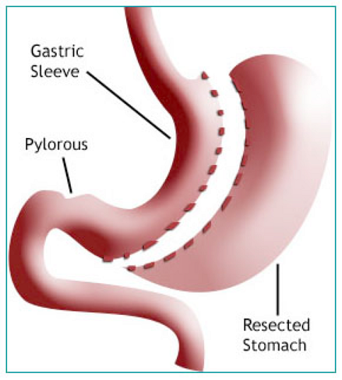 Complications sleeve bypass