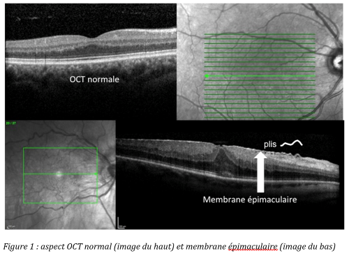 membraneepimaculairevis2