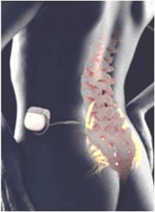 Neuromodulation sacrée