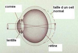 Œil Hypermetrope 