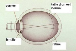 Oeil myope