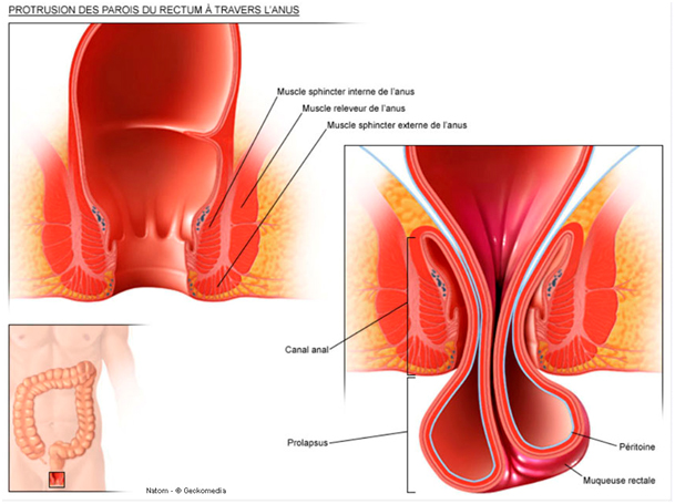 Parois rectum a travers anus