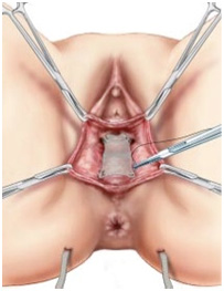 traitement chirurgical prolapsus voie vaginale