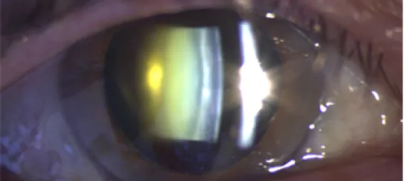 cataractevisuel3