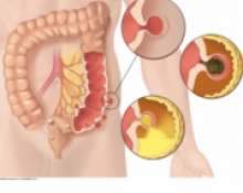 Diverticulose sigmoïdienne