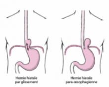 Hernie hiatale et Reflux gastro-oesophagien