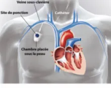 Pose de chambre implantable