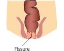 Fissure anale