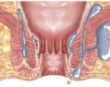 Fistule anale