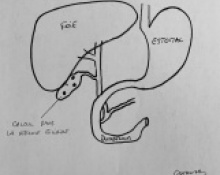 Cholécystectomie (ablation vésicule biliaire)
