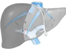Hépatectomie droite