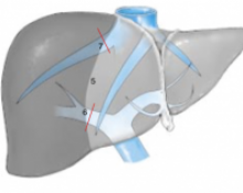 Hépatectomie droite