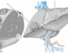 Tumorectomie hépatique