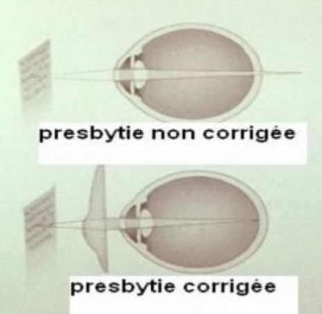 Schéma presbytie 