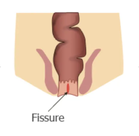 Fissure anale