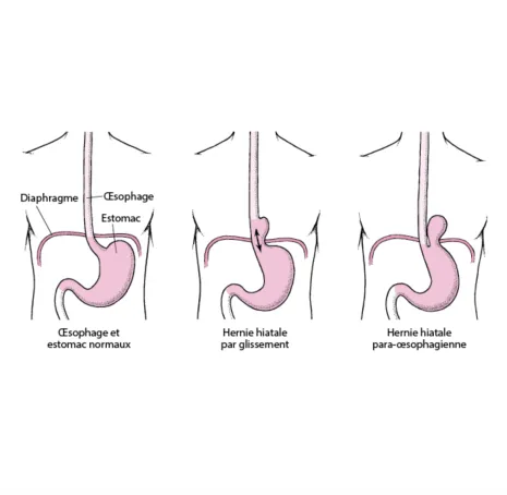 Hernie hiatale et Reflux gastro-oesophagien