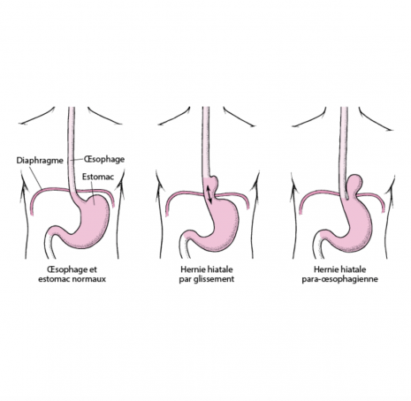 Hernie hiatale et Reflux gastro-oesophagien