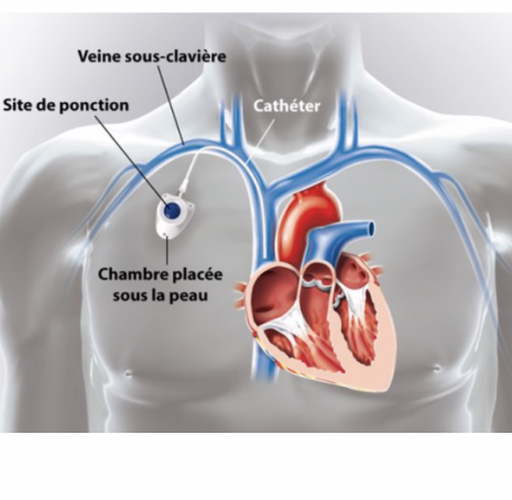 Pose de chambre implantable