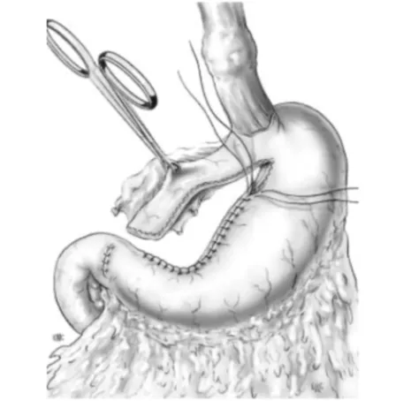 Cancer Oesophage