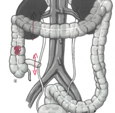 Cancer du colon droit