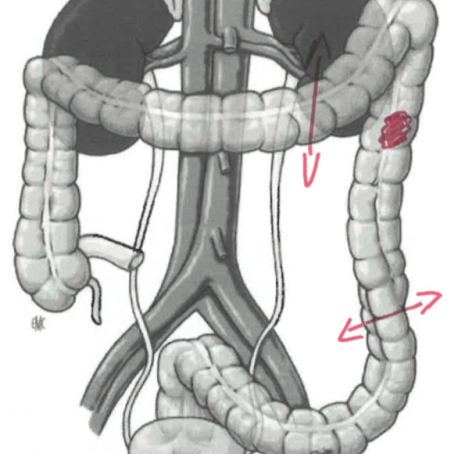 Cancer colon gauche