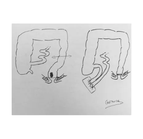 Cancer du rectum