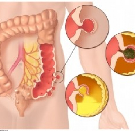 Diverticulose sigmoïdienne | AÉSIO Santé