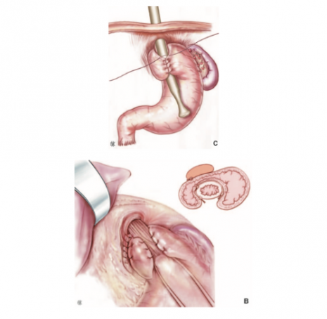 Hernie hiatale et Reflux gastro-oesophagien