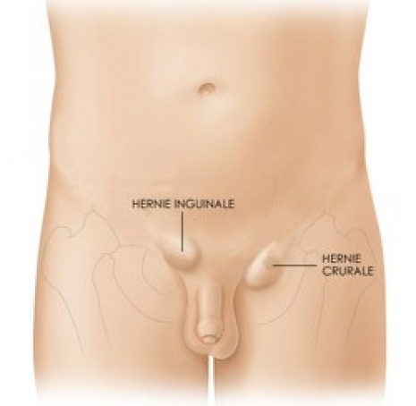 Hernies de l’aine