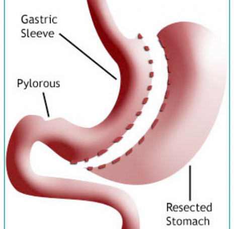 Gastrectomie en manchon ou sleeve gastrectomy - objectif de l'intervention