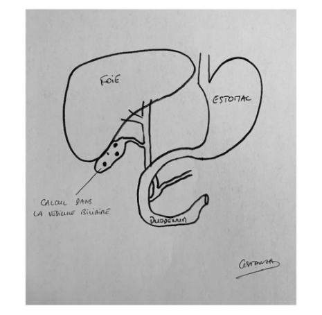 Cholécystectomie