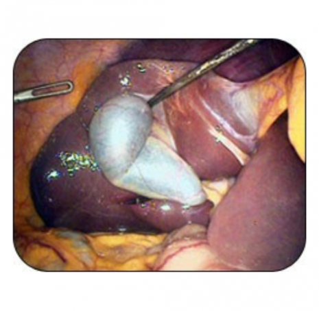 Cholécystectomie (ablation vésicule biliaire) | AÉSIO Santé